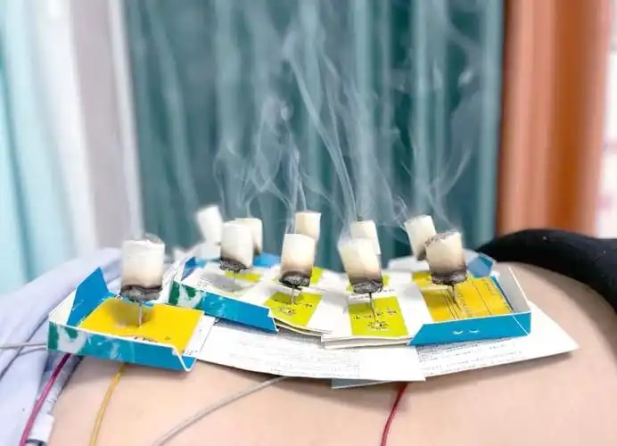 温针灸套餐
