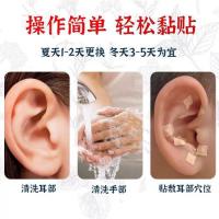 耳穴贴压理疗